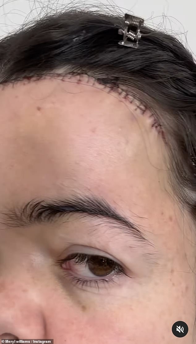 U Instagram kolu, Meryl je podijelila snimke preslikanih linija na čelu, gdje bi kirurg djelovao
