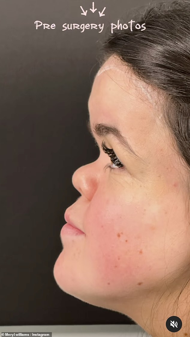 Škotski influencer objavio je fotografije prije operacije u kolu, pokazujući joj čelo sa strane, prije nego što je kasnije otkrio svoj novi izgled