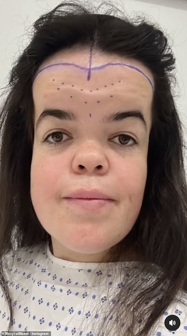 Meryl je podijelila snimke preslikanih linija na čelu, gdje bi kirurg djelovao
