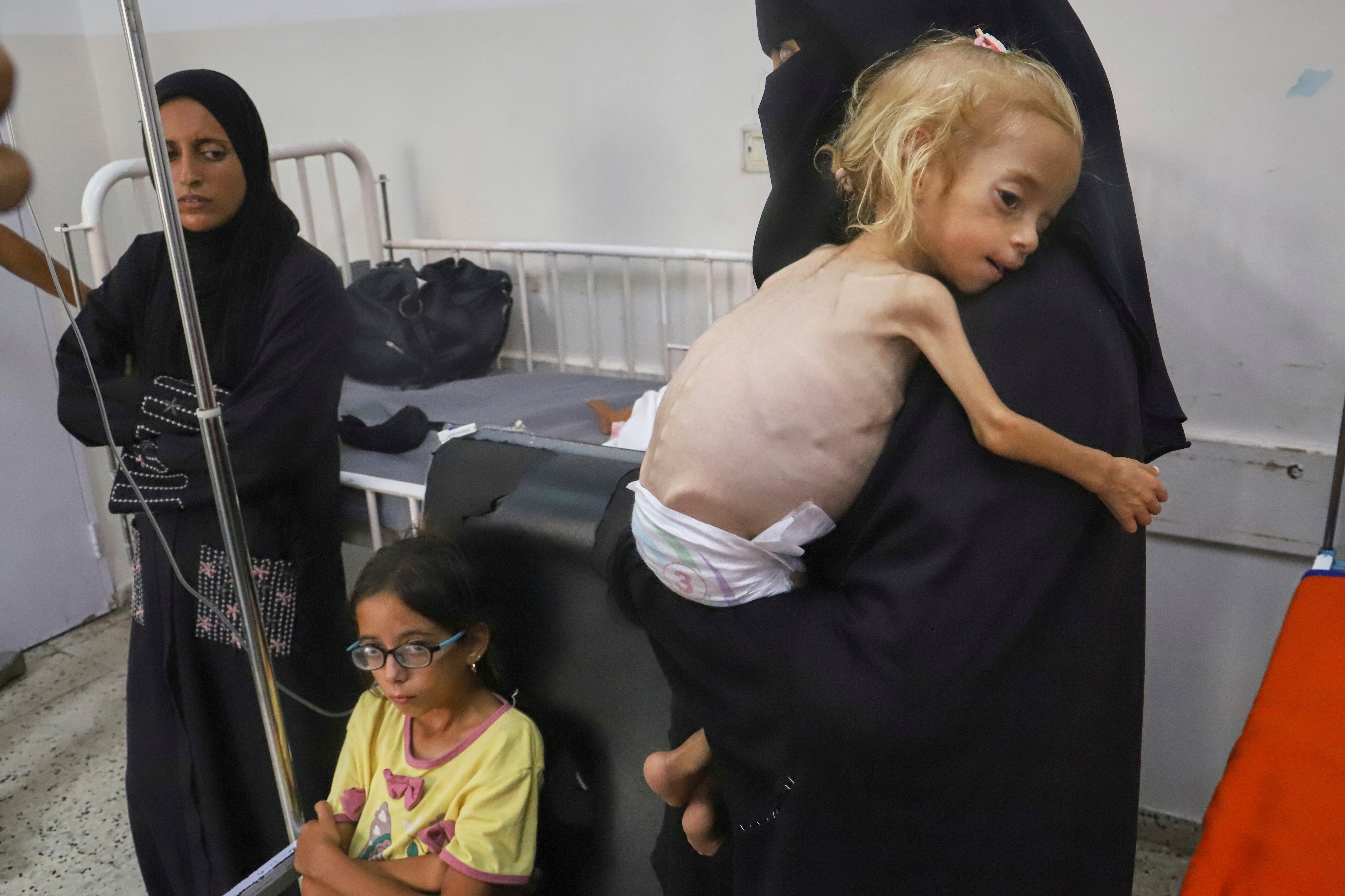 Teško pothranjena dvogodišnja djevojčica u bolnici Nasser u Khanu Younisu, Južna Gaza