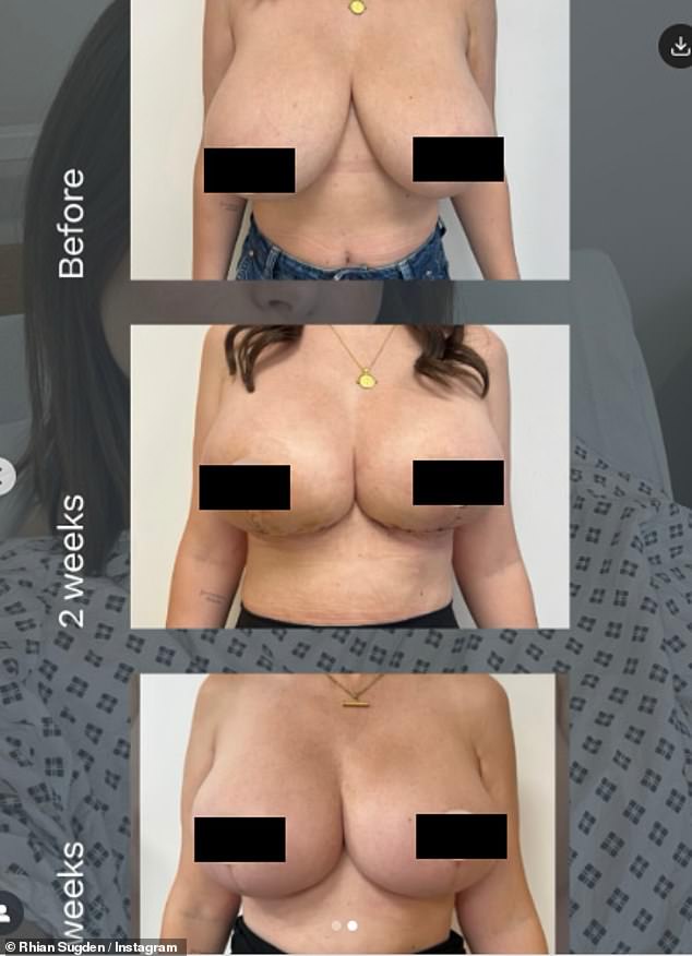 Izlazeći na Instagram, podijelila je tri topless fotografije sebe prije, dva tjedna nakon i nekoliko tjedana nakon operacije