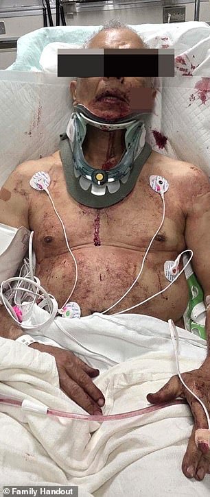 Perry Tole, vozač kamiona za mast, viđen je kako leži u bolničkom krevetu, prekriven krvlju s ogromnim grickalicama na licu i narukvicama oko vrata