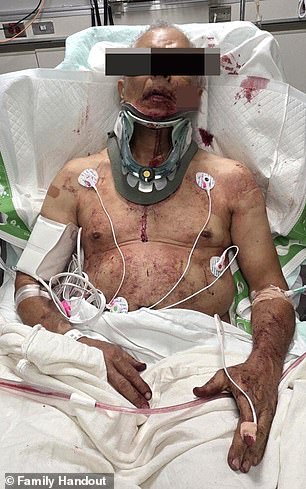 Perry Tole, vozač kamiona za mast, viđen je kako leži u bolničkom krevetu, prekriven krvlju s ogromnim grickalicama na licu i narukvicama oko vrata