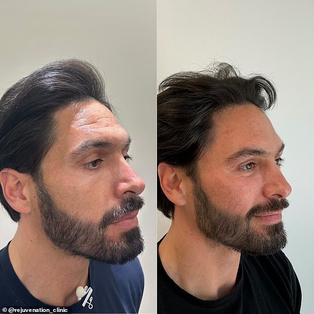 Prošao je niz tretmana uključujući dermalne punila, kemijske pilinge, botox i polinukleotide (kolokvijalno poznatije kao tretmani lica sa spermom lososa)