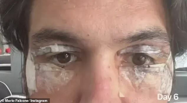 Prošle je godine Mario potrošio 3700 funti na operaciju blefaroplastike, kojom se uklanja višak kože ili masnoće s kapaka kako bi se smanjio izgled kapuljača ili spuštenih kapaka ili vrećica za oči