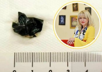 Slobodna Dalmacija – Doktorica Roje otkrila slučaj u Splitu: ‘Majka je bila uplakana, maleni je imao užasan zadah, dva i pol centimetra…’