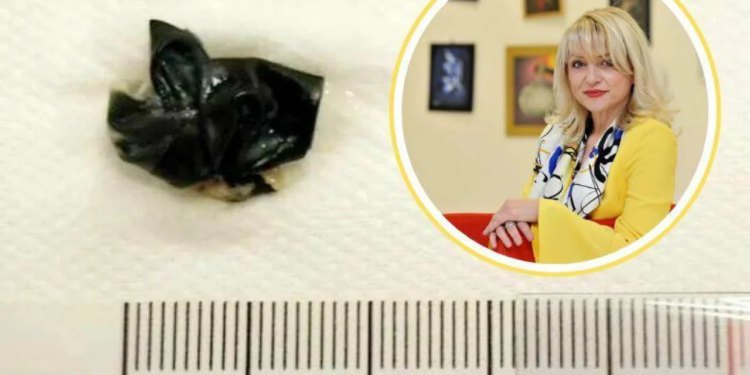 Slobodna Dalmacija – Doktorica Roje otkrila slučaj u Splitu: ‘Majka je bila uplakana, maleni je imao užasan zadah, dva i pol centimetra…’