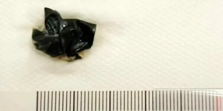 Splićanka dovela dijete na pregled, liječnica u šoku: ‘Stajalo mu je to u nosu mjesecima’