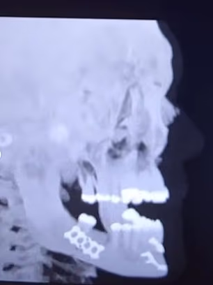 Također je otkrio da će biti prisiljen jesti na slamku sedam dana nakon vađenja zuba