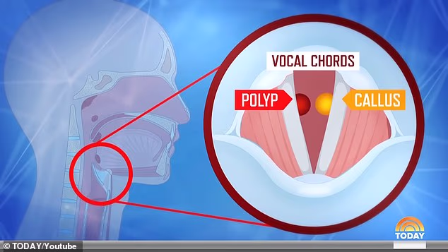 Guthriejev vokalni stručnjak, dr. Peak Wu, uklonio je polip i kvržicu sa svake strane glasnica TV voditelja