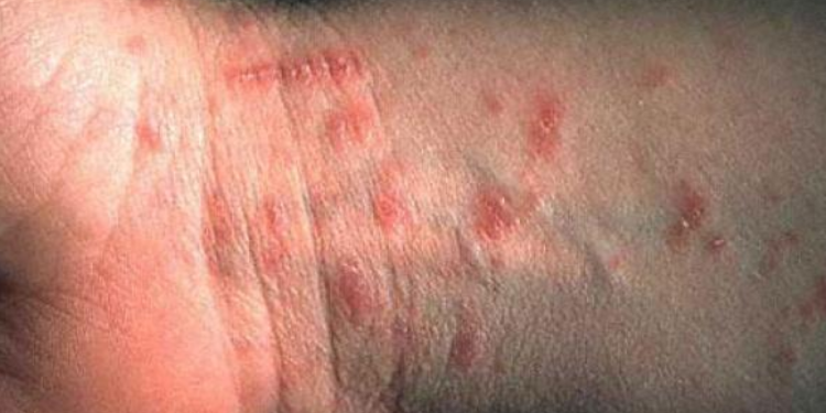 Dubrovački dermatolog i infektologinja o pojavi svraba: Prenosi se bliskim i dugotrajnim kontaktom, a uzročnika se ovako može eliminirati