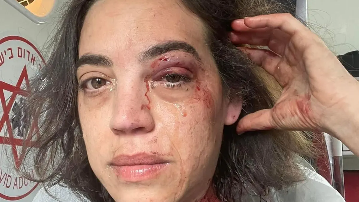 Michal Weits nakon ranjavanja u iranskom projektilu