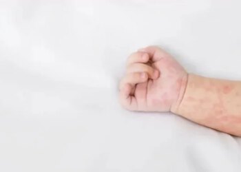 Potvrđena dva slučaja morbila u HNŽ-u, procijepljenost iznosi tek 25 posto