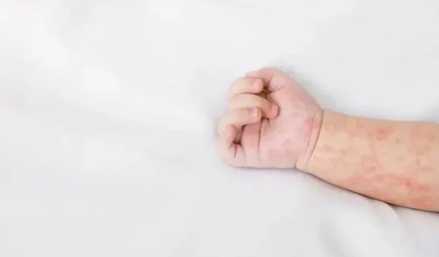 Potvrđena dva slučaja morbila u HNŽ-u, procijepljenost iznosi tek 25 posto