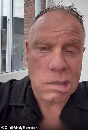 Morrison je u ožujku otkrio obožavateljima da mu je dijagnosticiran Ramsay Hunt sindrom