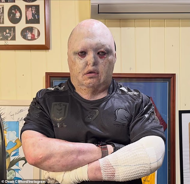 Unatoč tome što pati od mučne kožne bolesti bulozne epidermolize, 43-godišnjak je postao vrhunski powerlifter uz svoj posao motivacijskog govornika