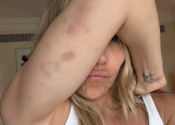 Sienna Miller pokazuje svoje modrice i nesreće s oružjem na setu Jacka Ryana nakon što je priznala da se ‘bacila’ na supruga najbolje prijateljice Emily Blunt, Johna Krasinskog kako bi dobila ulogu