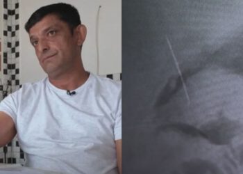 Štefek iz Kutine 10 godina trpio užasne bolove, pogledajte što su mu pronašli u tijelu