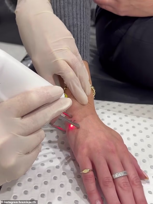 U videu se može vidjeti kako laserski uklanja tetovažu kako bi se riješila tinte