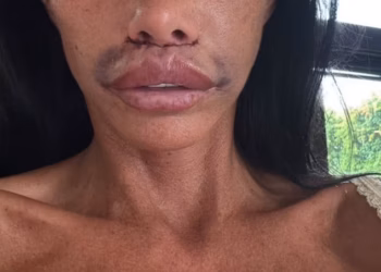 Katie Price pokazuje svoje natečeno lice u novom izdanju nakon podvrgavanja korektivnoj operaciji punjenja usana